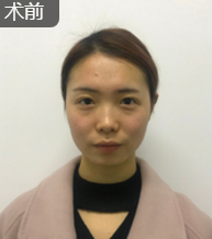 面部提升术