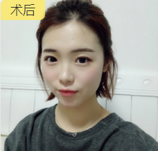 面部提升术