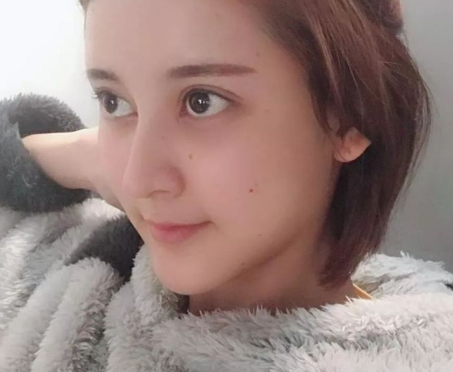 自体脂肪填充术
