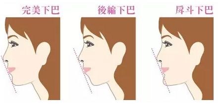 隆下巴