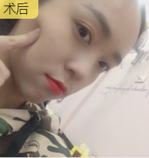 双眼皮手术