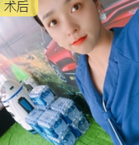 双眼皮手术