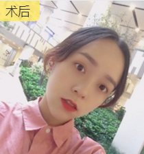 双眼皮手术