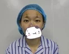自体脂肪填充术