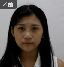 自体脂肪填充术