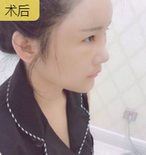 自体脂肪填充术
