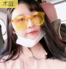自体脂肪填充术
