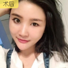 自体脂肪填充术