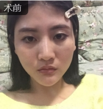 自体脂肪填充术