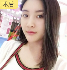 自体脂肪填充术