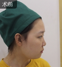 超声波瘦脸