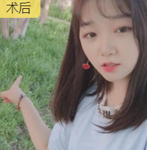 超声波瘦脸