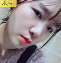 超声波瘦脸