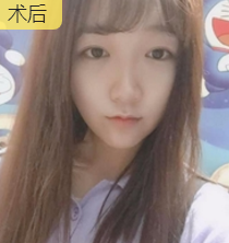 超声波瘦脸