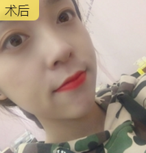 双眼皮手术