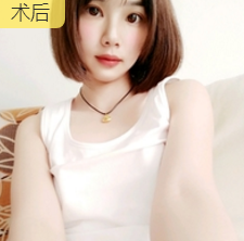 双眼皮手术