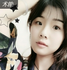 双眼皮手术