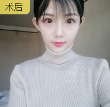双眼皮手术