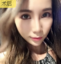 面部提升术