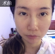 面部提升术