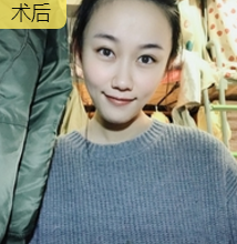 超声波瘦脸