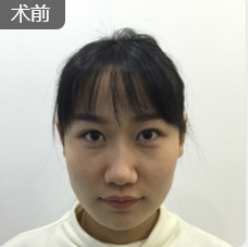 超声波瘦脸