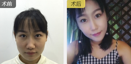 超声波瘦脸