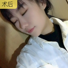 超声波瘦脸
