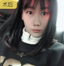 超声波瘦脸