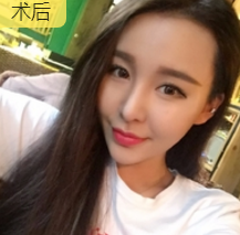 面部提升术