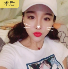 面部提升术