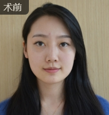 隆鼻手术