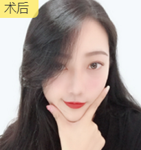 隆鼻手术