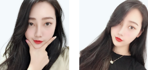 隆鼻手术
