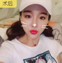 面部提升术