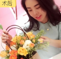面部提升术