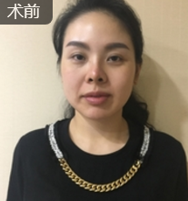 面部提升术
