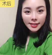 面部提升术