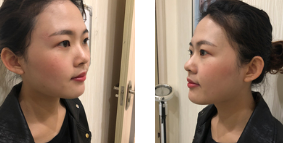 双眼皮手术