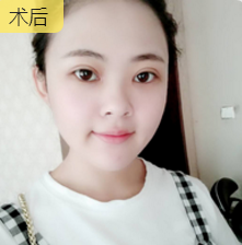 双眼皮手术