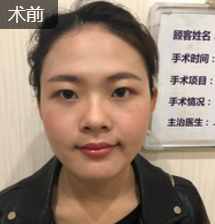 双眼皮手术