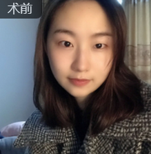 双眼皮手术