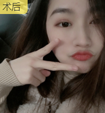 双眼皮手术