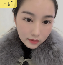 双眼皮手术