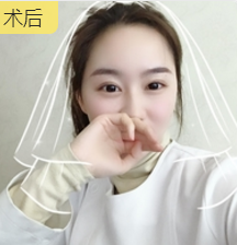 双眼皮手术