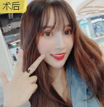 超声波双眼皮