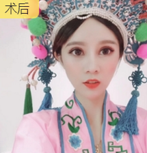 超声波双眼皮