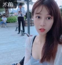 超声波双眼皮
