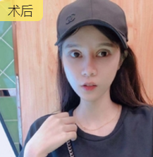 超声波双眼皮