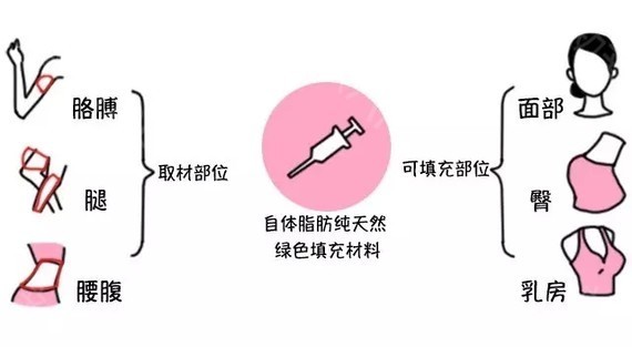自体脂肪填充术